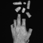 Hanne's Broken Hand III